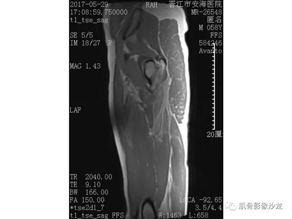 【病例】股骨骨纤维结构不良/骨纤维异常增殖症1例X线MR影像表现 【病例】股骨骨纤维结构不良/骨纤维异常增殖症1例X线MR影像表现