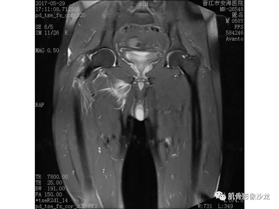 【病例】股骨骨纤维结构不良/骨纤维异常增殖症1例X线MR影像表现 【病例】股骨骨纤维结构不良/骨纤维异常增殖症1例X线MR影像表现
