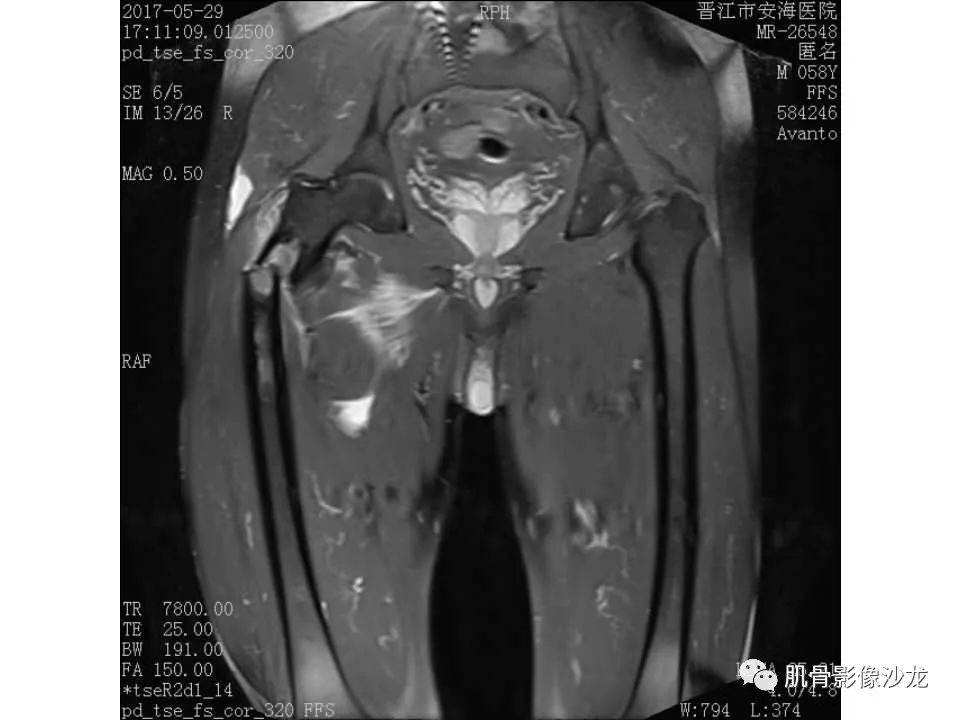【病例】股骨骨纤维结构不良/骨纤维异常增殖症1例X线MR影像表现 【病例】股骨骨纤维结构不良/骨纤维异常增殖症1例X线MR影像表现