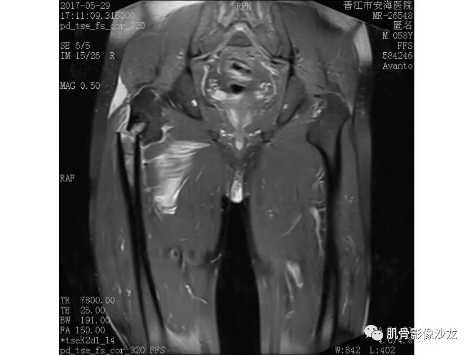 【病例】股骨骨纤维结构不良/骨纤维异常增殖症1例X线MR影像表现 【病例】股骨骨纤维结构不良/骨纤维异常增殖症1例X线MR影像表现