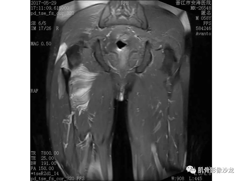 【病例】股骨骨纤维结构不良/骨纤维异常增殖症1例X线MR影像表现 【病例】股骨骨纤维结构不良/骨纤维异常增殖症1例X线MR影像表现