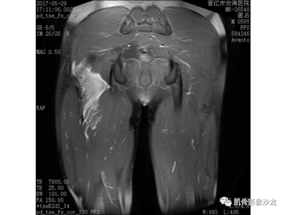 【病例】股骨骨纤维结构不良/骨纤维异常增殖症1例X线MR影像表现 【病例】股骨骨纤维结构不良/骨纤维异常增殖症1例X线MR影像表现