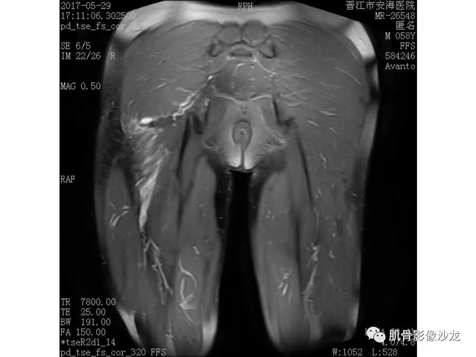 【病例】股骨骨纤维结构不良/骨纤维异常增殖症1例X线MR影像表现 【病例】股骨骨纤维结构不良/骨纤维异常增殖症1例X线MR影像表现
