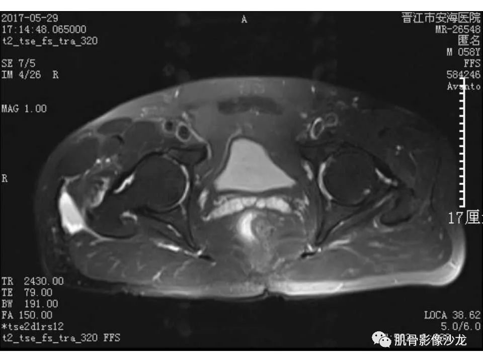 【病例】股骨骨纤维结构不良/骨纤维异常增殖症1例X线MR影像表现 【病例】股骨骨纤维结构不良/骨纤维异常增殖症1例X线MR影像表现