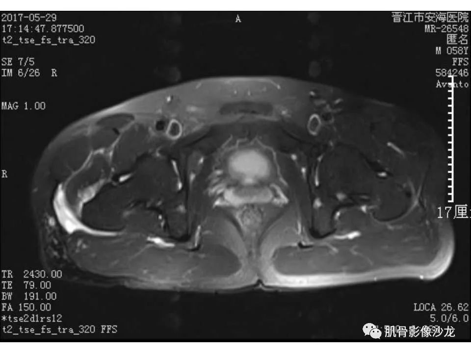 【病例】股骨骨纤维结构不良/骨纤维异常增殖症1例X线MR影像表现 【病例】股骨骨纤维结构不良/骨纤维异常增殖症1例X线MR影像表现