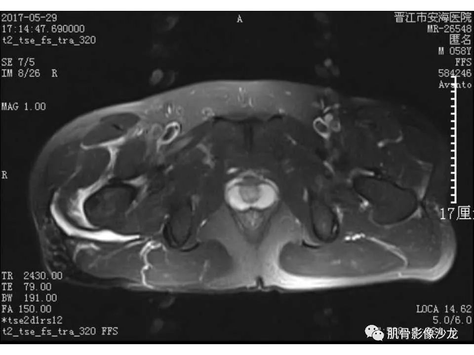 【病例】股骨骨纤维结构不良/骨纤维异常增殖症1例X线MR影像表现 【病例】股骨骨纤维结构不良/骨纤维异常增殖症1例X线MR影像表现