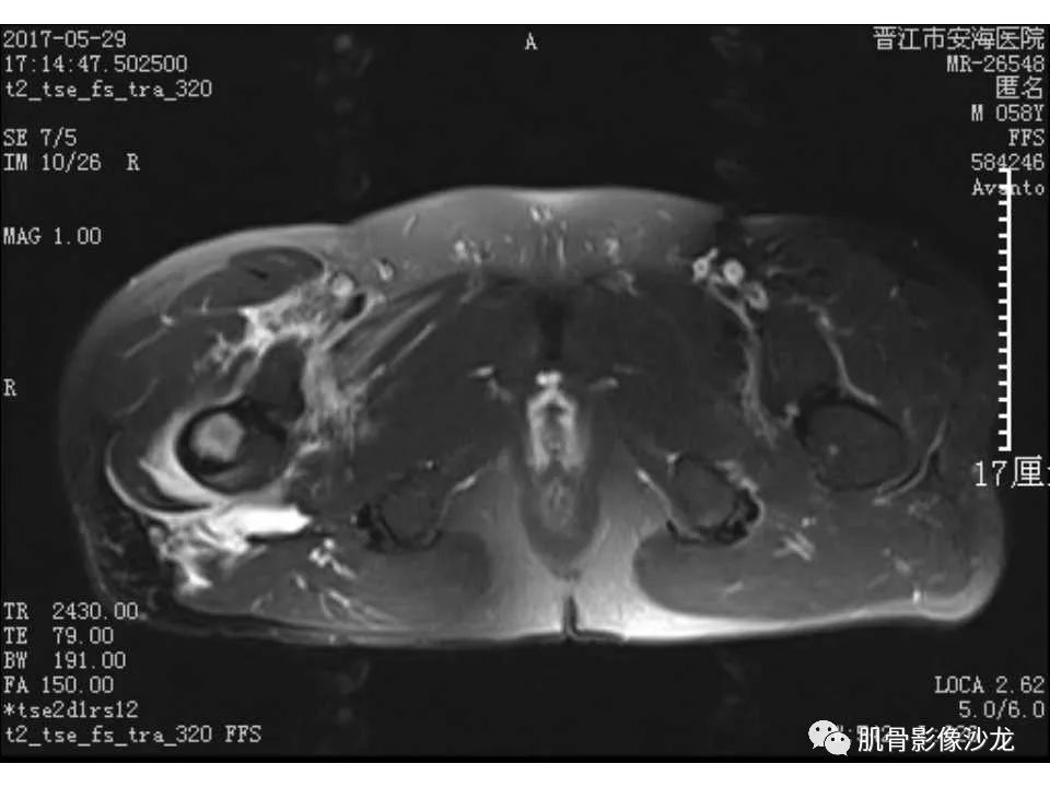 【病例】股骨骨纤维结构不良/骨纤维异常增殖症1例X线MR影像表现 【病例】股骨骨纤维结构不良/骨纤维异常增殖症1例X线MR影像表现