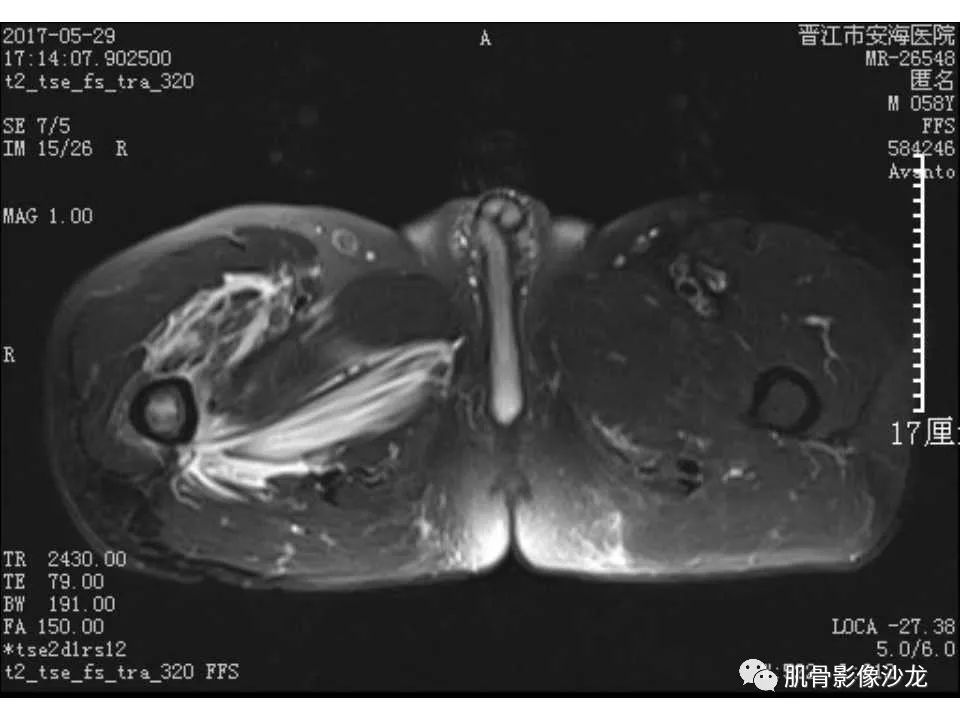 【病例】股骨骨纤维结构不良/骨纤维异常增殖症1例X线MR影像表现 【病例】股骨骨纤维结构不良/骨纤维异常增殖症1例X线MR影像表现