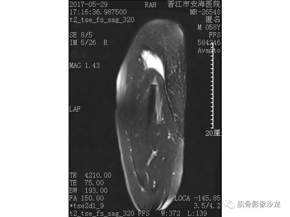 【病例】股骨骨纤维结构不良/骨纤维异常增殖症1例X线MR影像表现 【病例】股骨骨纤维结构不良/骨纤维异常增殖症1例X线MR影像表现