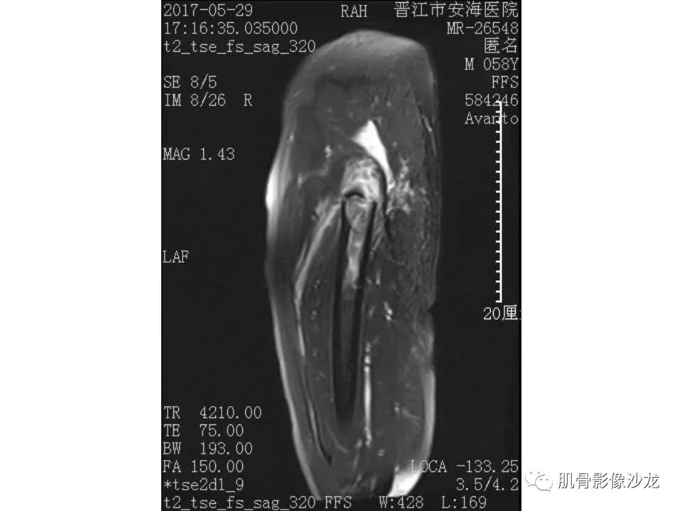 【病例】股骨骨纤维结构不良/骨纤维异常增殖症1例X线MR影像表现 【病例】股骨骨纤维结构不良/骨纤维异常增殖症1例X线MR影像表现