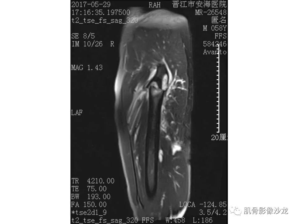 【病例】股骨骨纤维结构不良/骨纤维异常增殖症1例X线MR影像表现 【病例】股骨骨纤维结构不良/骨纤维异常增殖症1例X线MR影像表现