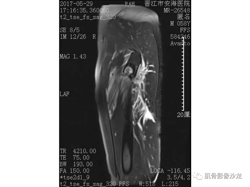 【病例】股骨骨纤维结构不良/骨纤维异常增殖症1例X线MR影像表现 【病例】股骨骨纤维结构不良/骨纤维异常增殖症1例X线MR影像表现