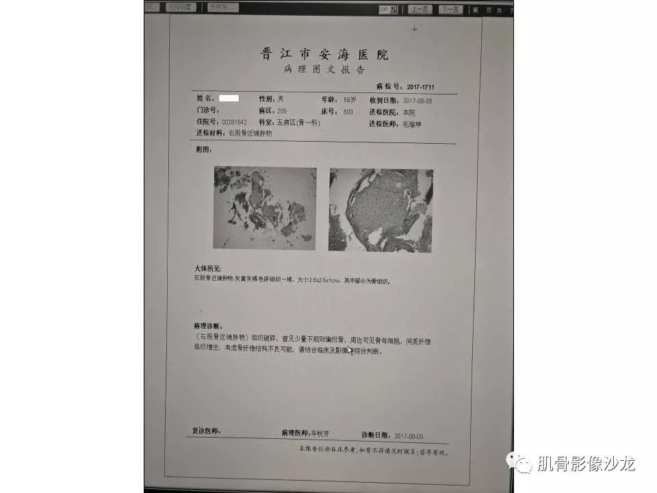 【病例】股骨骨纤维结构不良/骨纤维异常增殖症1例X线MR影像表现 【病例】股骨骨纤维结构不良/骨纤维异常增殖症1例X线MR影像表现