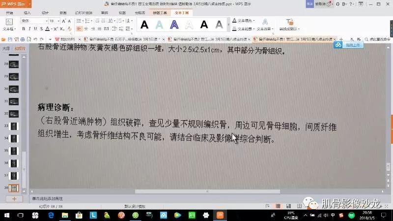 【病例】股骨骨纤维结构不良/骨纤维异常增殖症1例X线MR影像表现 【病例】股骨骨纤维结构不良/骨纤维异常增殖症1例X线MR影像表现