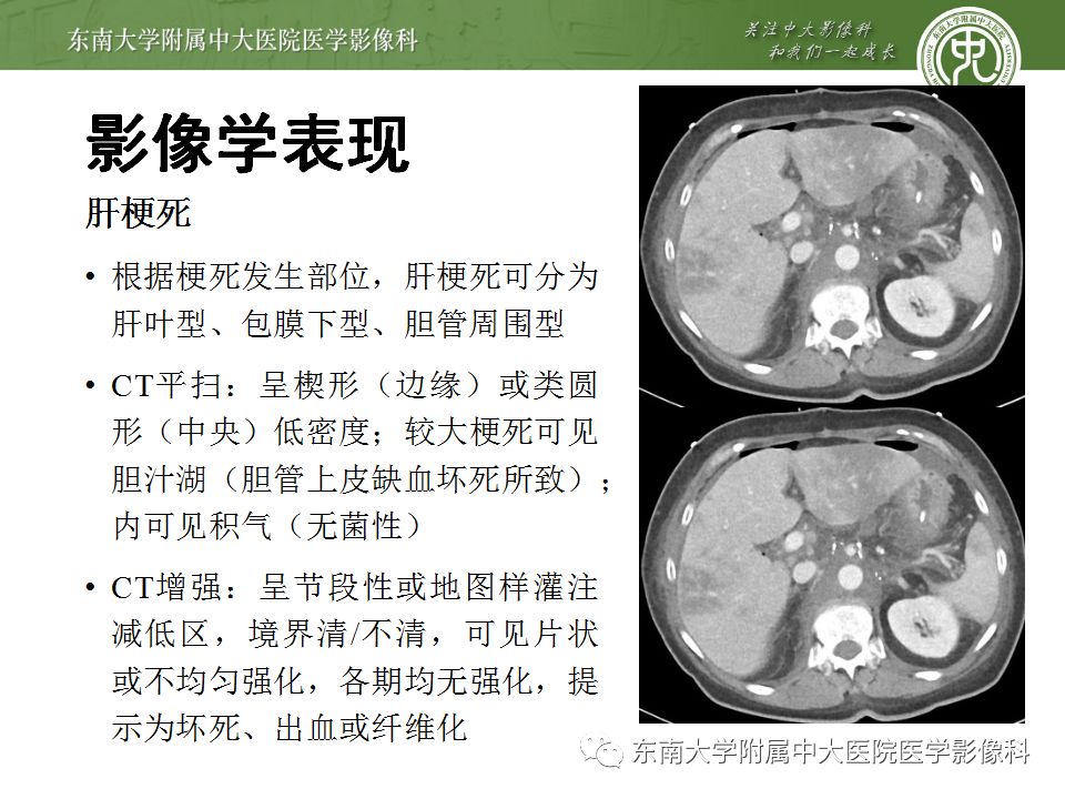 【病例】肝缺血性改变1例CT影像表现 【病例】肝缺血性改变1例CT影像表现