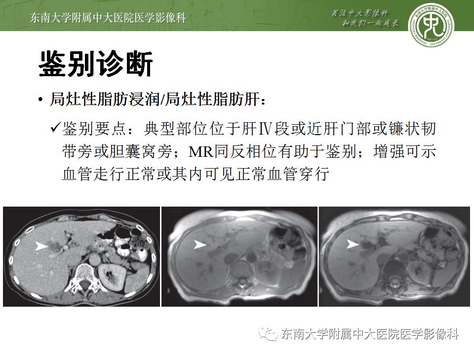 【病例】肝缺血性改变1例CT影像表现 【病例】肝缺血性改变1例CT影像表现