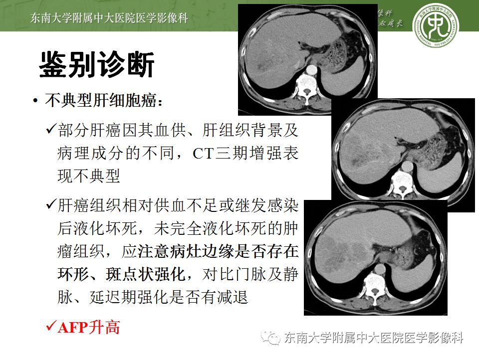 【病例】肝缺血性改变1例CT影像表现 【病例】肝缺血性改变1例CT影像表现