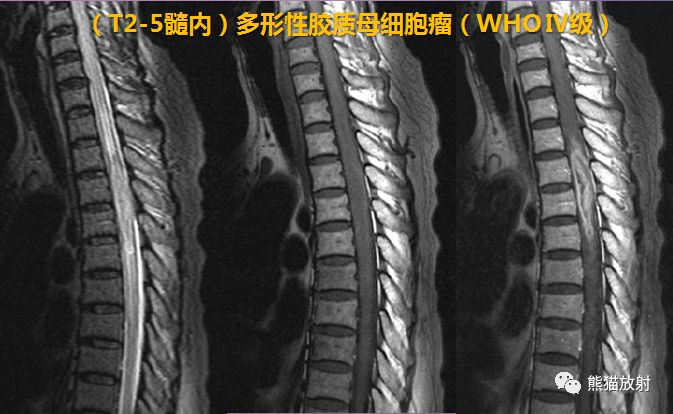 髓内神经鞘瘤 髓内神经鞘瘤
