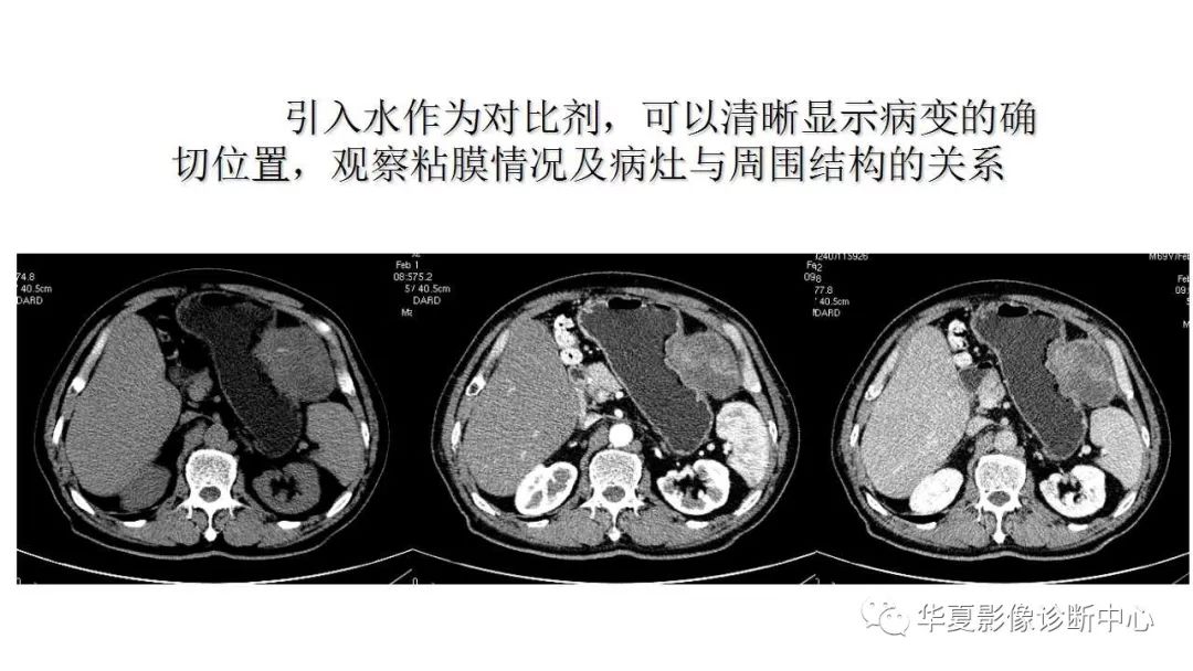 【病例】胃肠道间质瘤1例CT影像表现