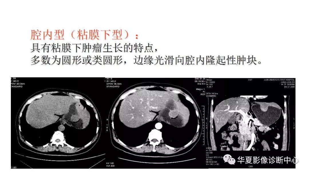 【病例】胃肠道间质瘤1例CT影像表现