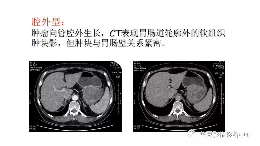 【病例】胃肠道间质瘤1例CT影像表现