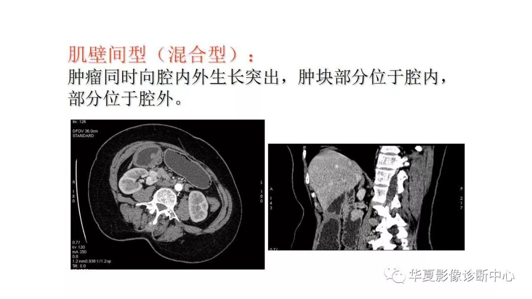 【病例】胃肠道间质瘤1例CT影像表现