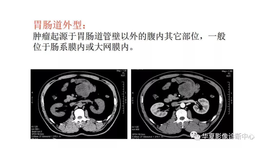 【病例】胃肠道间质瘤1例CT影像表现