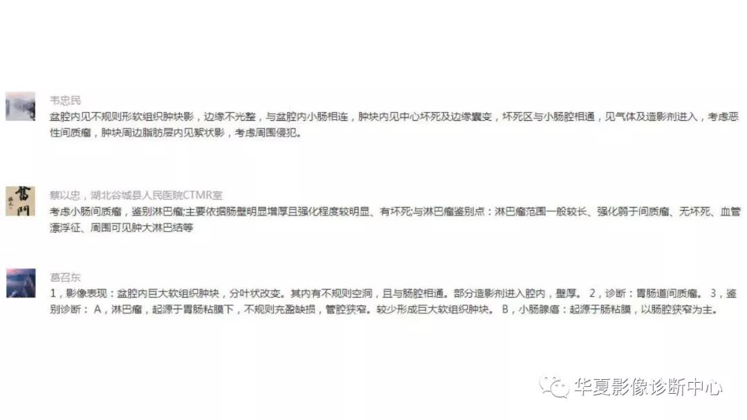 【病例】胃肠道间质瘤1例CT影像表现