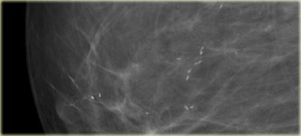 怎样从形态和分布鉴别乳腺钙化性质? 怎样从形态和分布鉴别乳腺钙化性质?