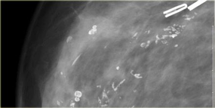 怎样从形态和分布鉴别乳腺钙化性质? 怎样从形态和分布鉴别乳腺钙化性质?