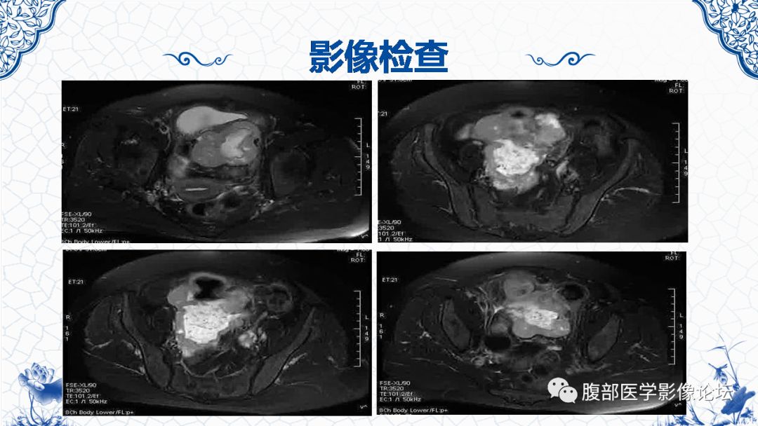 【病例】盆腔胃肠道间质瘤1例MR影像表现
