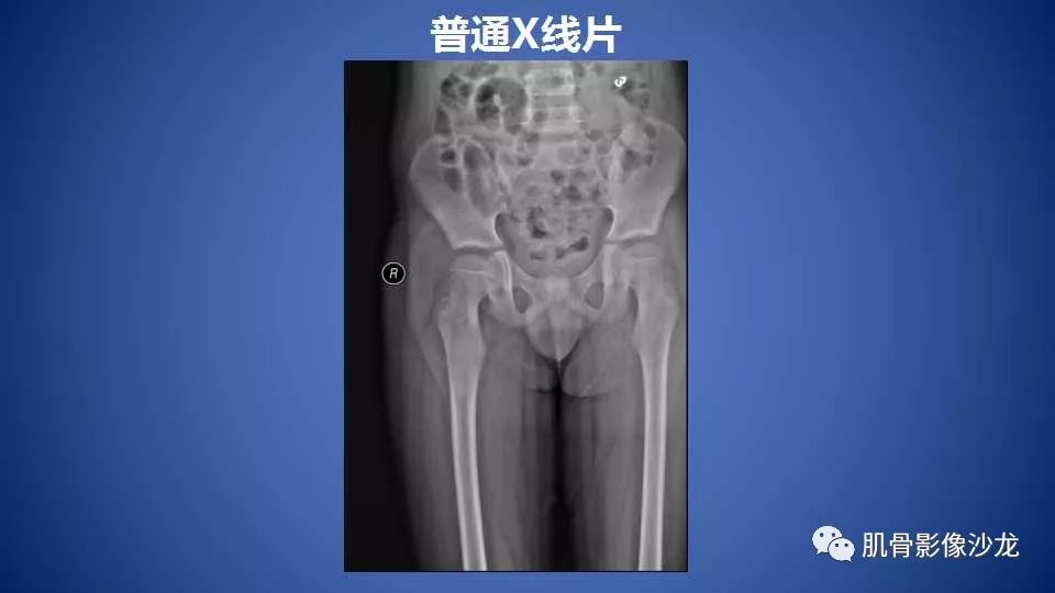 【病例】股骨骨纤维异常增殖症1例X线CT及MR影像讨论 【病例】股骨骨纤维异常增殖症1例X线CT及MR影像讨论