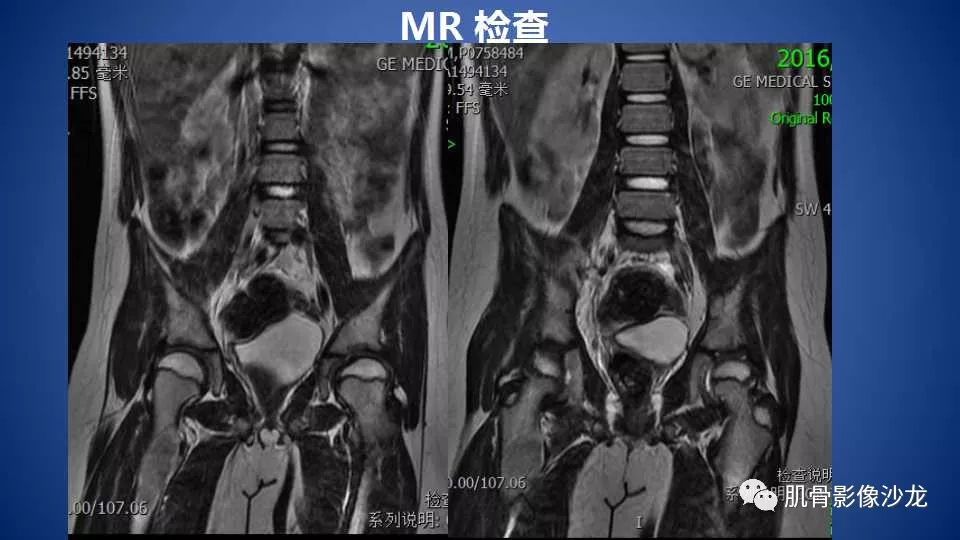 【病例】股骨骨纤维异常增殖症1例X线CT及MR影像讨论 【病例】股骨骨纤维异常增殖症1例X线CT及MR影像讨论