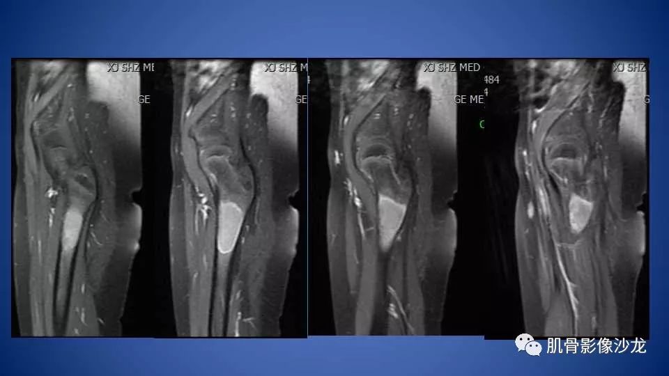 【病例】股骨骨纤维异常增殖症1例X线CT及MR影像讨论 【病例】股骨骨纤维异常增殖症1例X线CT及MR影像讨论