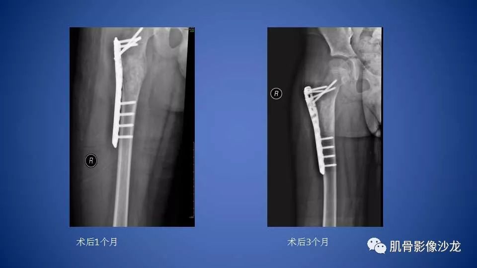 【病例】股骨骨纤维异常增殖症1例X线CT及MR影像讨论 【病例】股骨骨纤维异常增殖症1例X线CT及MR影像讨论