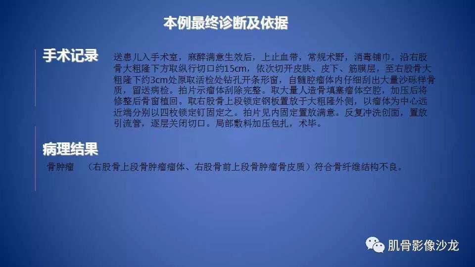 【病例】股骨骨纤维异常增殖症1例X线CT及MR影像讨论 【病例】股骨骨纤维异常增殖症1例X线CT及MR影像讨论