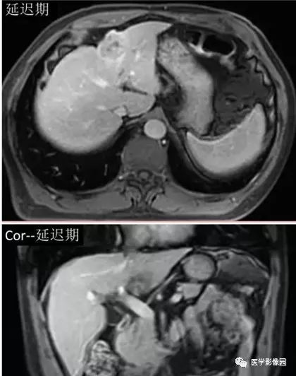 【病例】胆管细胞癌1例MR影像表现 【病例】胆管细胞癌1例MR影像表现
