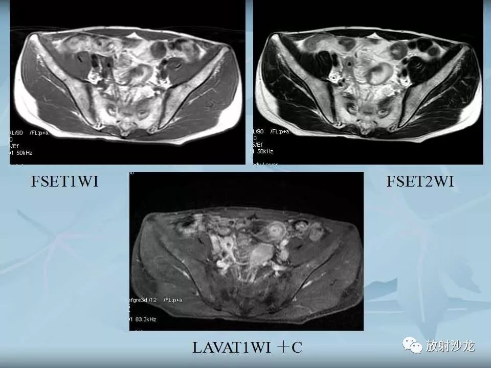 【病例】盆腔脓肿1例MR影像表现