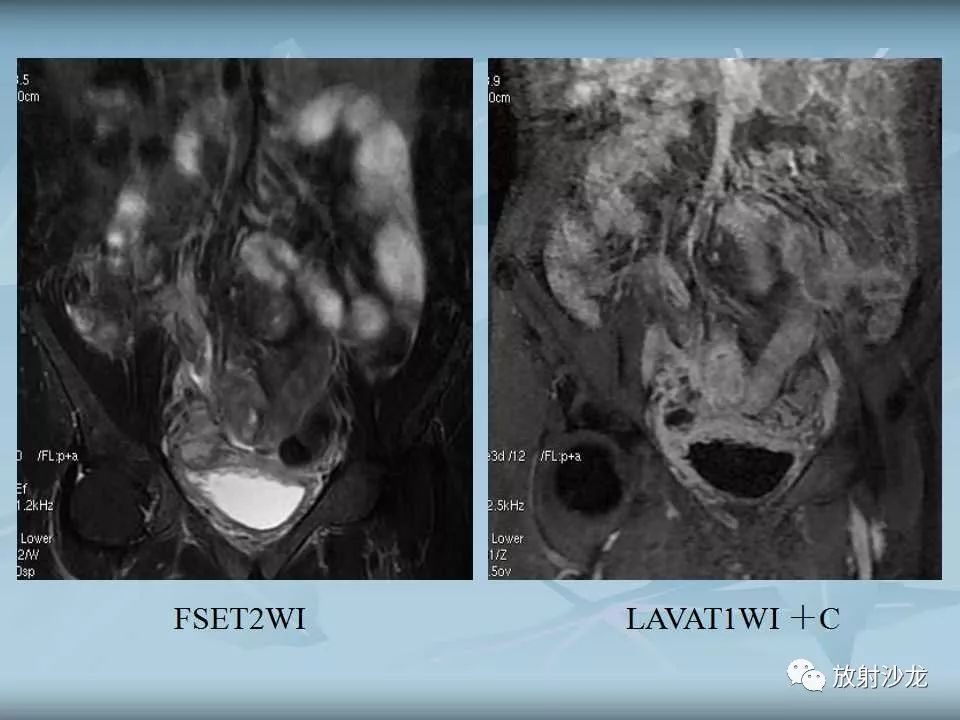 【病例】盆腔脓肿1例MR影像表现