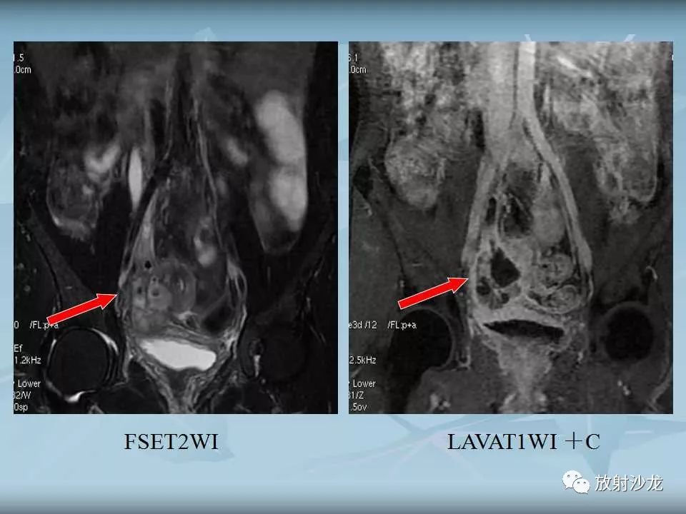 【病例】盆腔脓肿1例MR影像表现