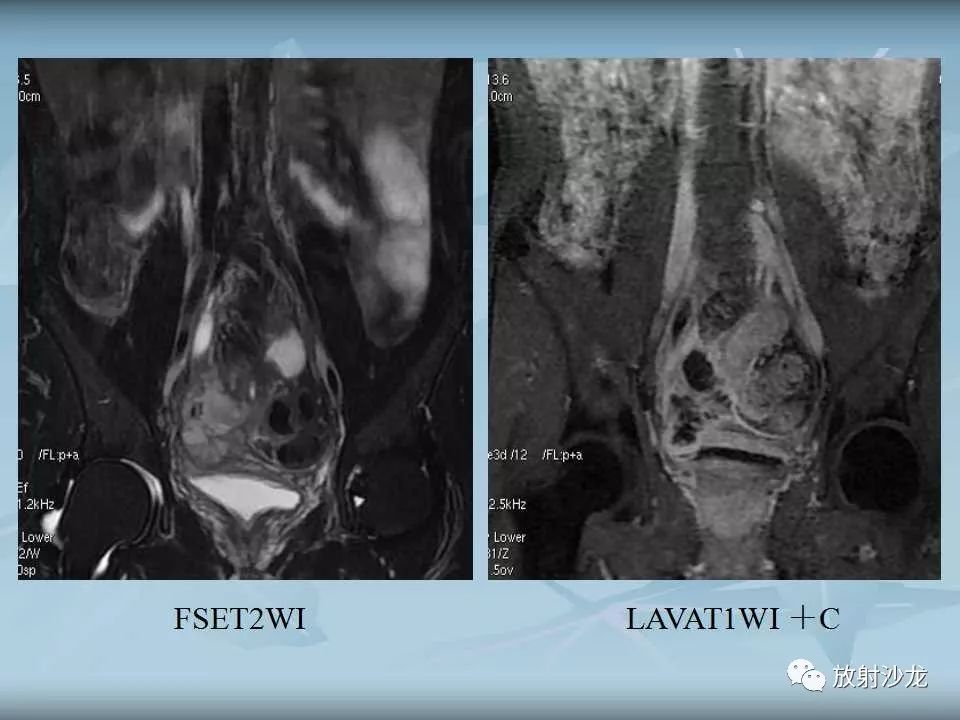 【病例】盆腔脓肿1例MR影像表现