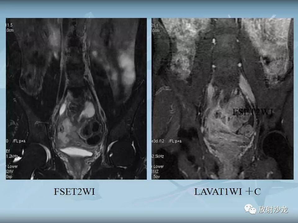 【病例】盆腔脓肿1例MR影像表现