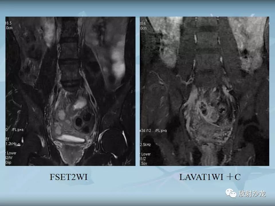 【病例】盆腔脓肿1例MR影像表现