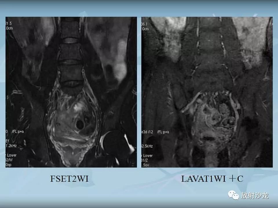 【病例】盆腔脓肿1例MR影像表现