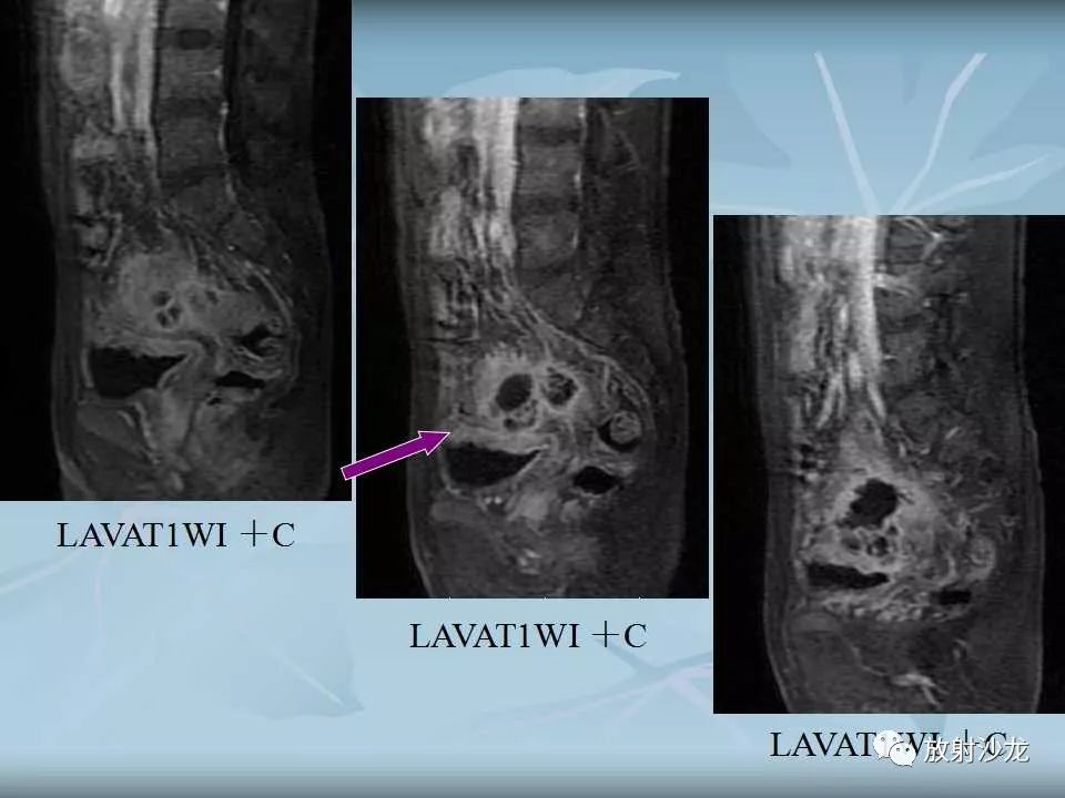 【病例】盆腔脓肿1例MR影像表现
