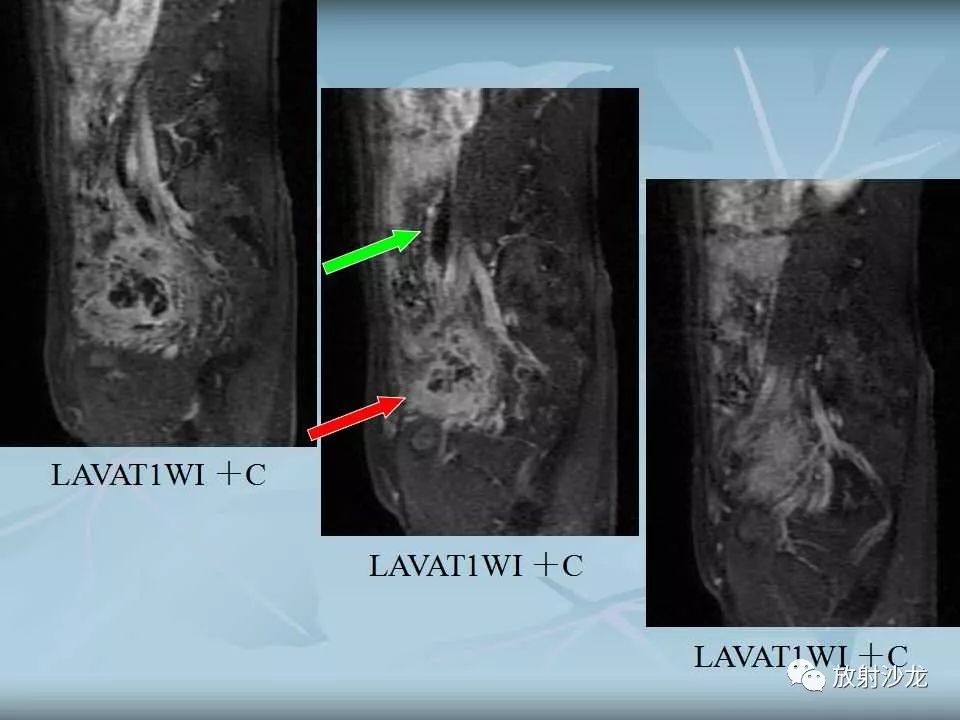 【病例】盆腔脓肿1例MR影像表现