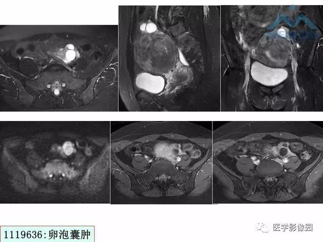 【PPT】MR对卵巢囊性病变的鉴别诊断价值