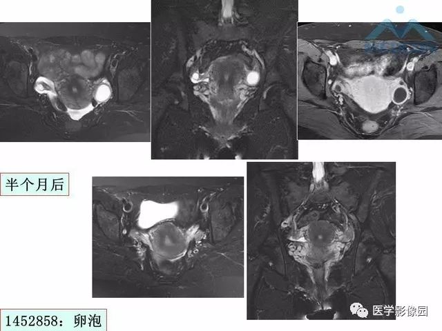【PPT】MR对卵巢囊性病变的鉴别诊断价值