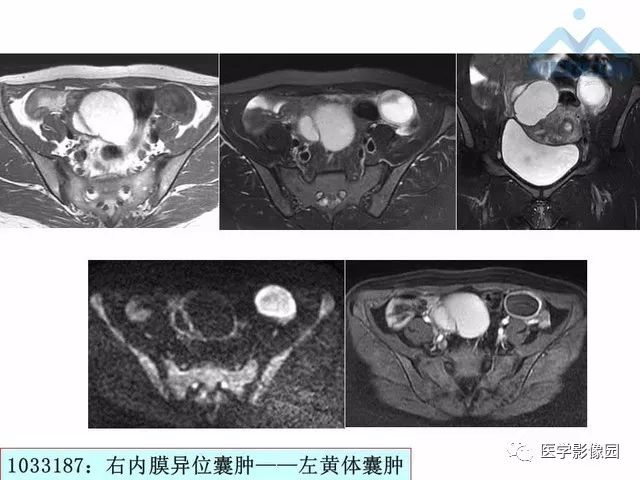 【PPT】MR对卵巢囊性病变的鉴别诊断价值