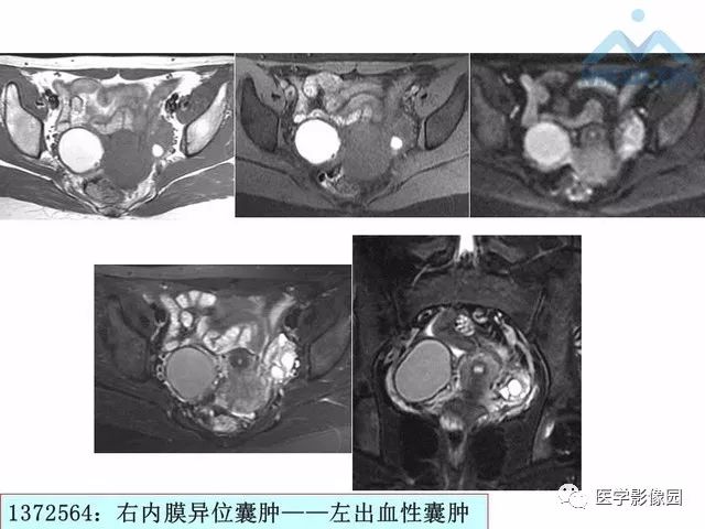 【PPT】MR对卵巢囊性病变的鉴别诊断价值